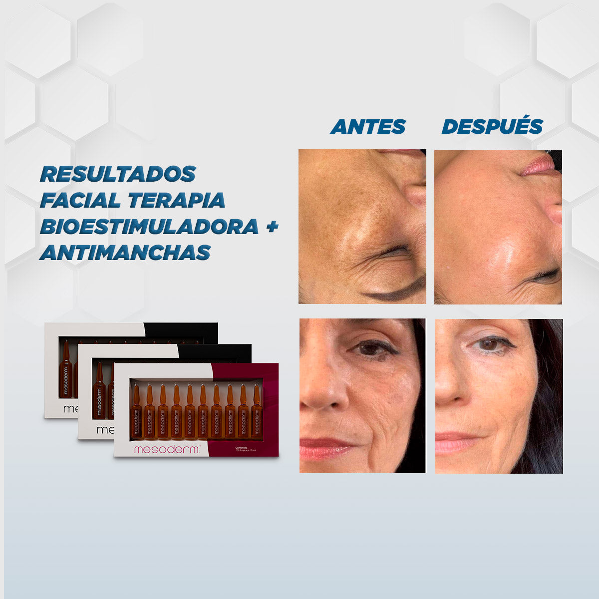 Tratamiento Facial Terapia Bioestimuladora + Antimanchas