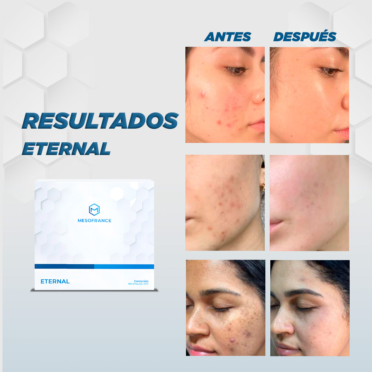 Tratamiento de Mesoterapia Facial con Eternal