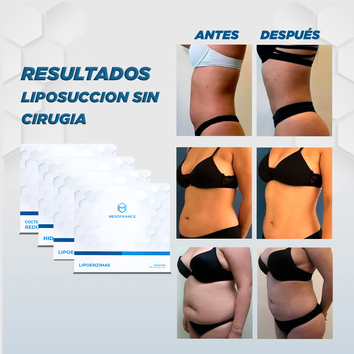 Tratamiento liposucción sin cirugía