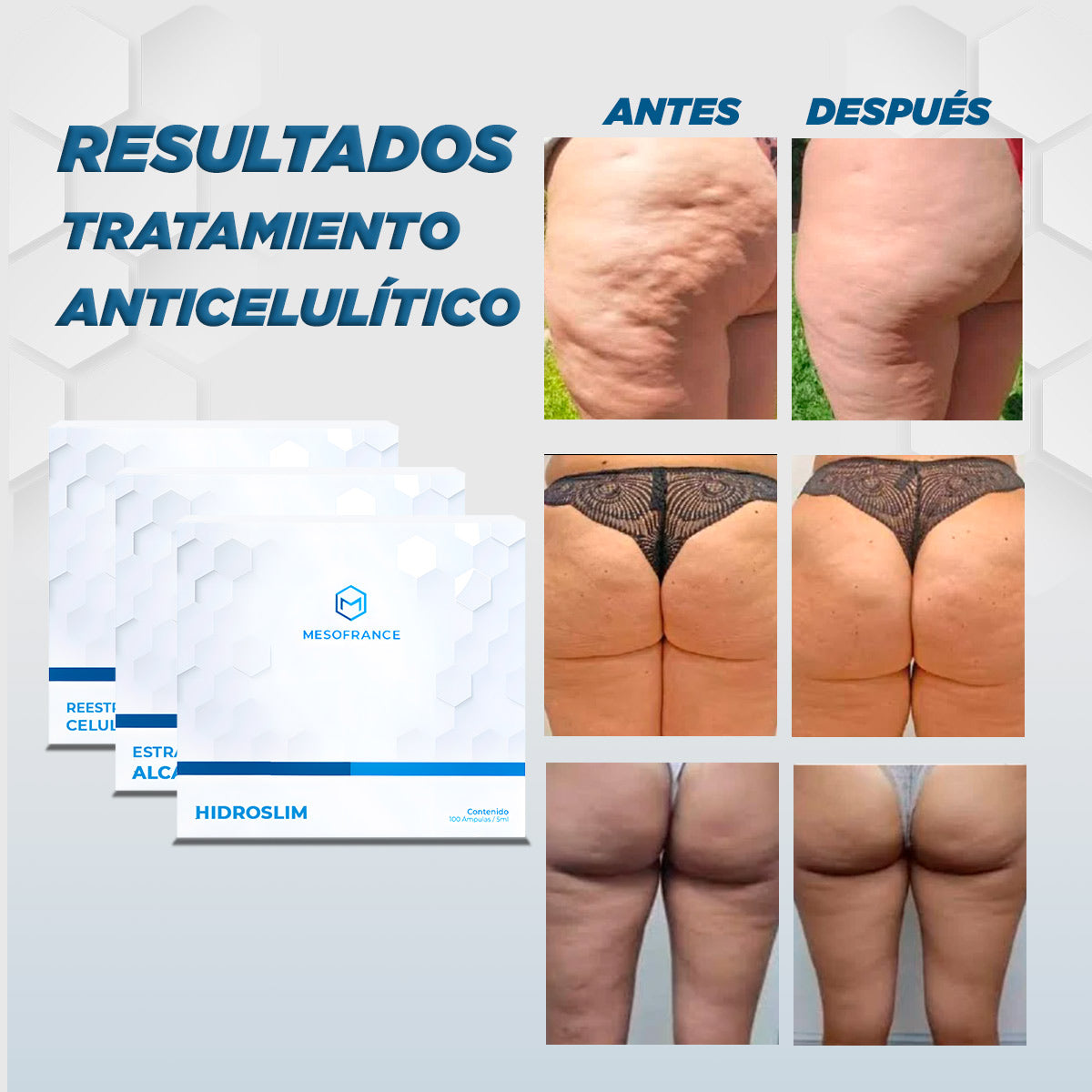 Tratamiento Anticelulítico