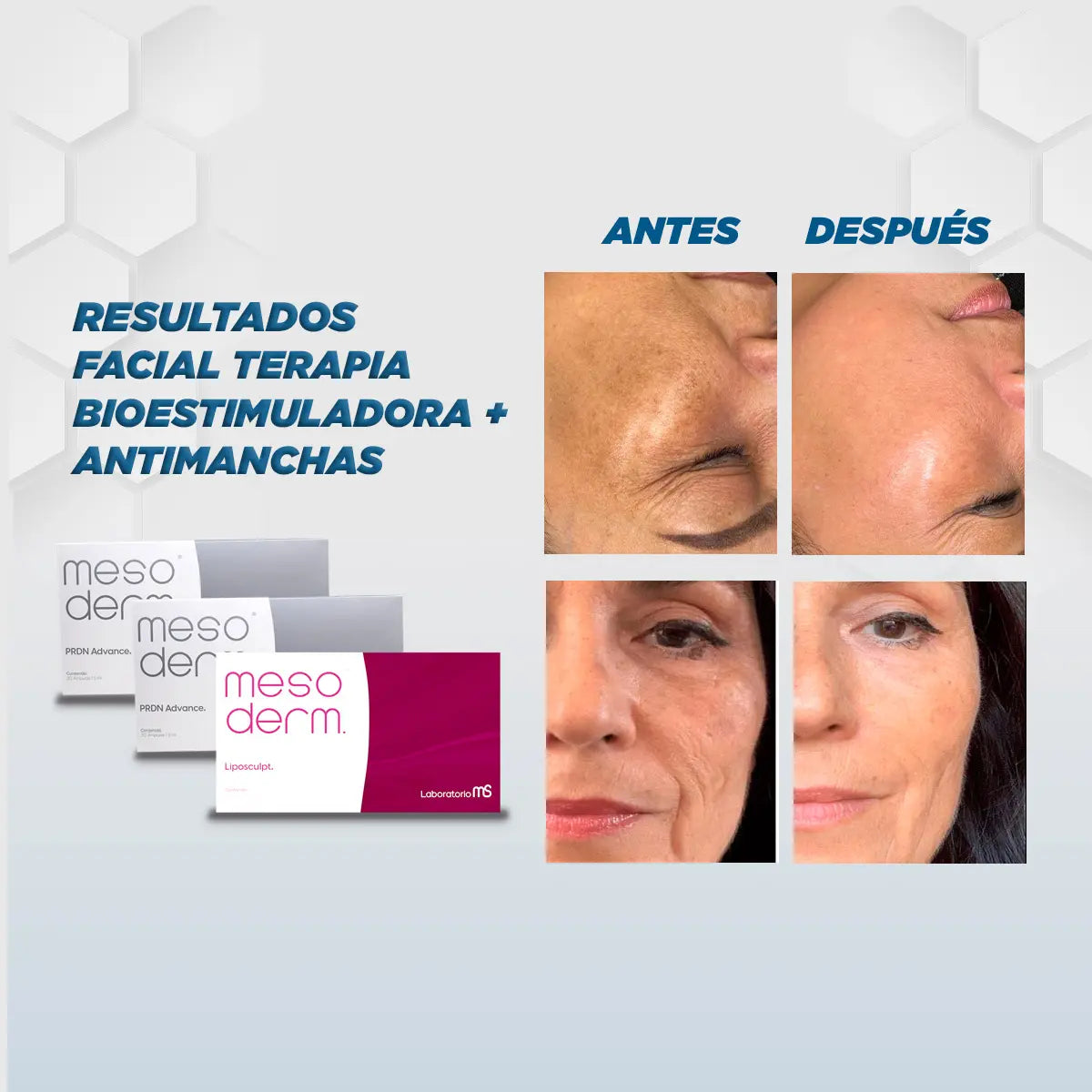 Tratamiento Facial Terapia Bioestimuladora + Antimanchas