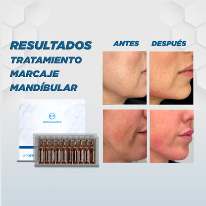 Tratamiento Marcaje Mandibular con Lipoenzimas