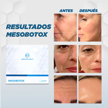 Tratamiento Mesobotox Facial