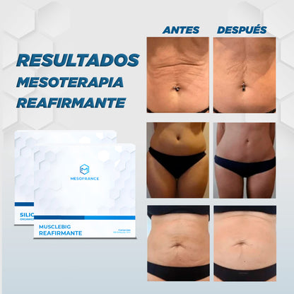 Tratamiento de Mesoterapia Reafirmante