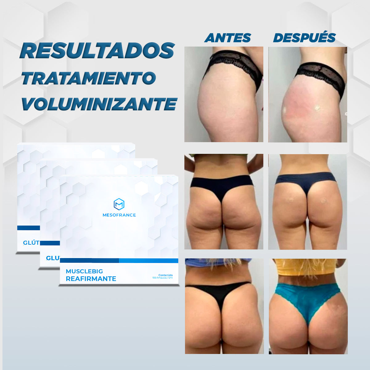 Tratamiento de Volumen para Gluteos y Piernas